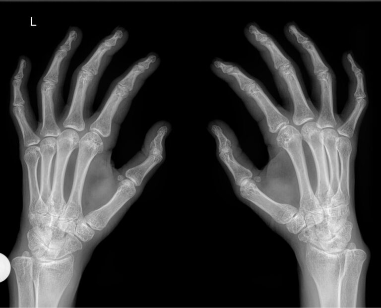 Рентген обеих кистей