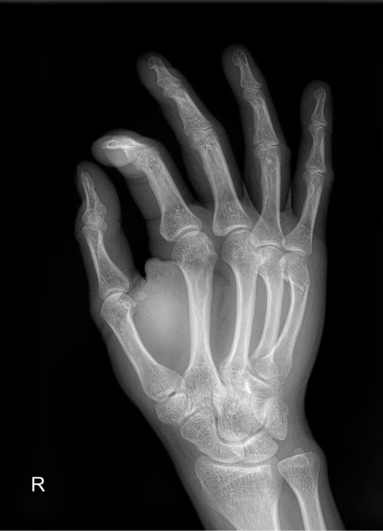 Рентген кисти