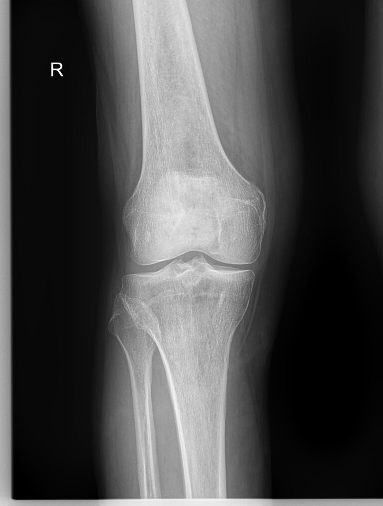 Рентген коленного сустава
