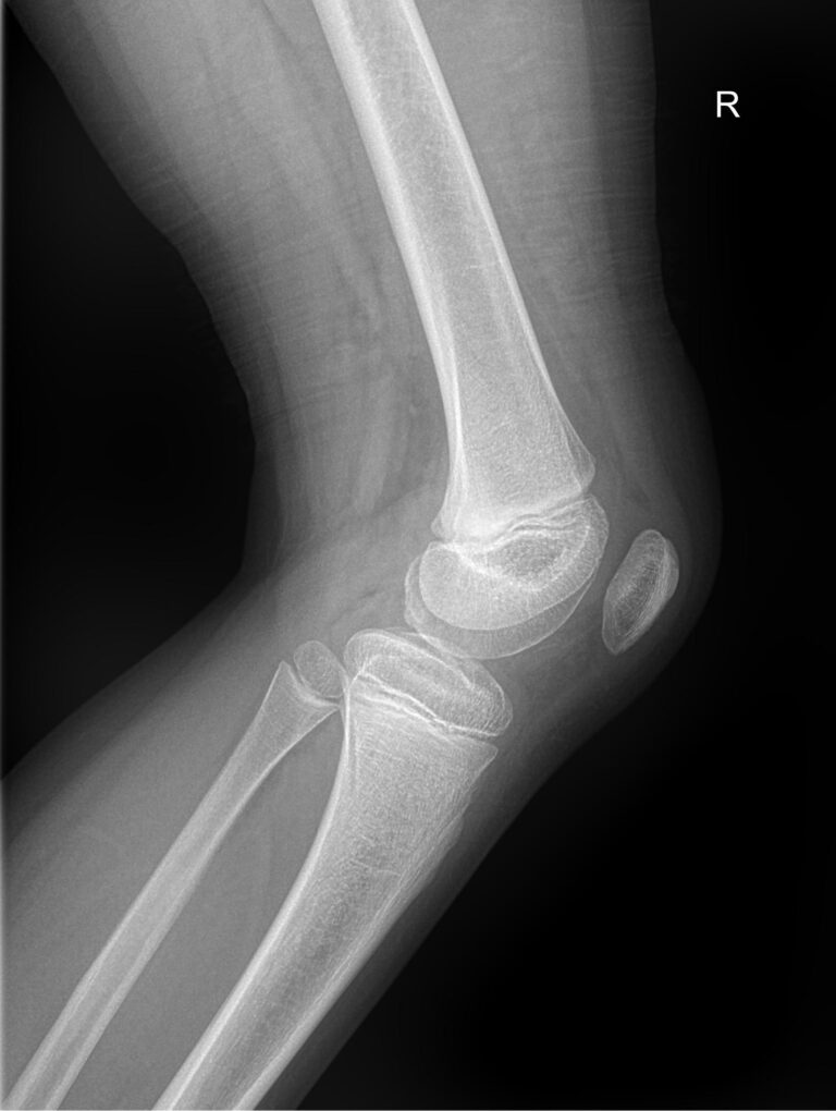 Рентген обоих коленных суставов