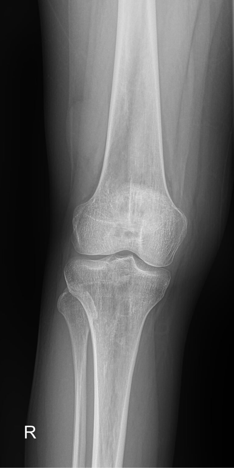 Рентген коленного сустава