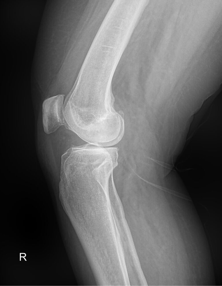 Рентген коленного сустава