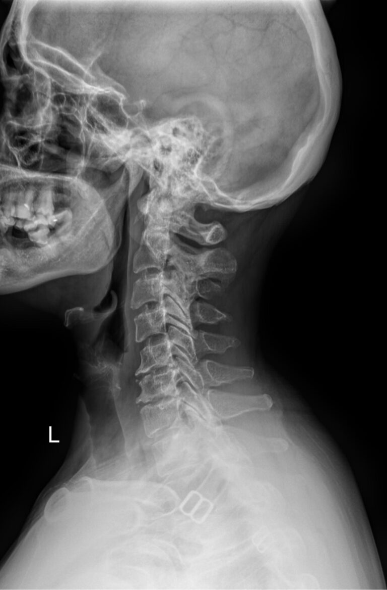 Функциональные исследования позвоночника (шейный отдел)
