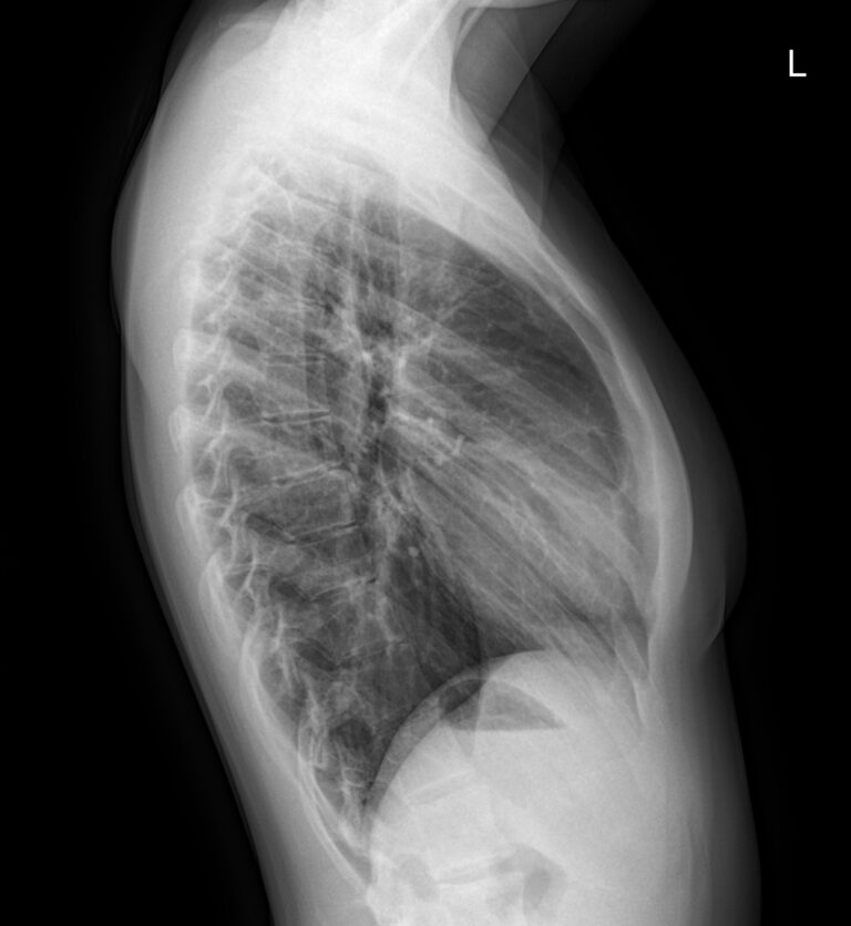 Рентген грудной клетки 2 проекции