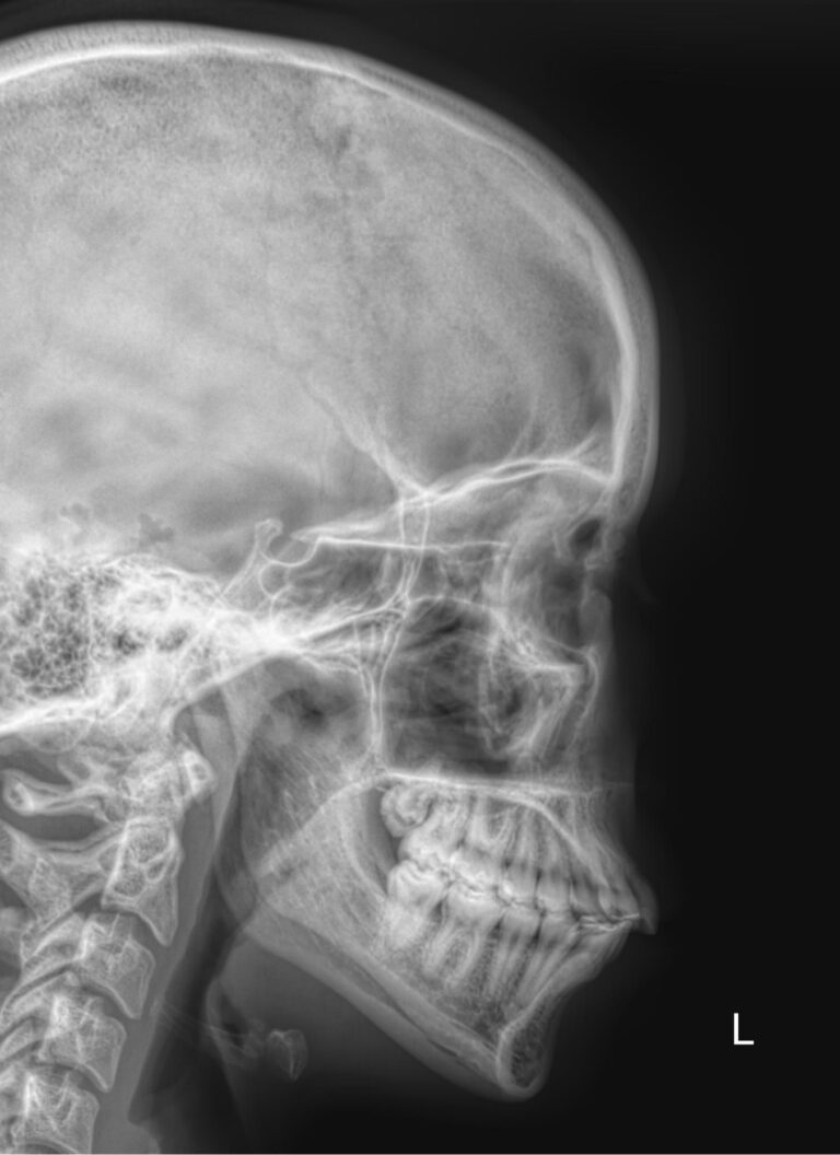 Рентген придаточных пазух носа