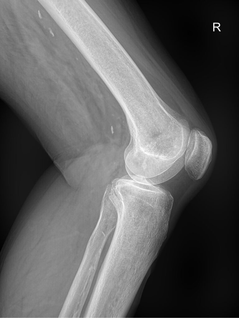 Рентген коленного сустава