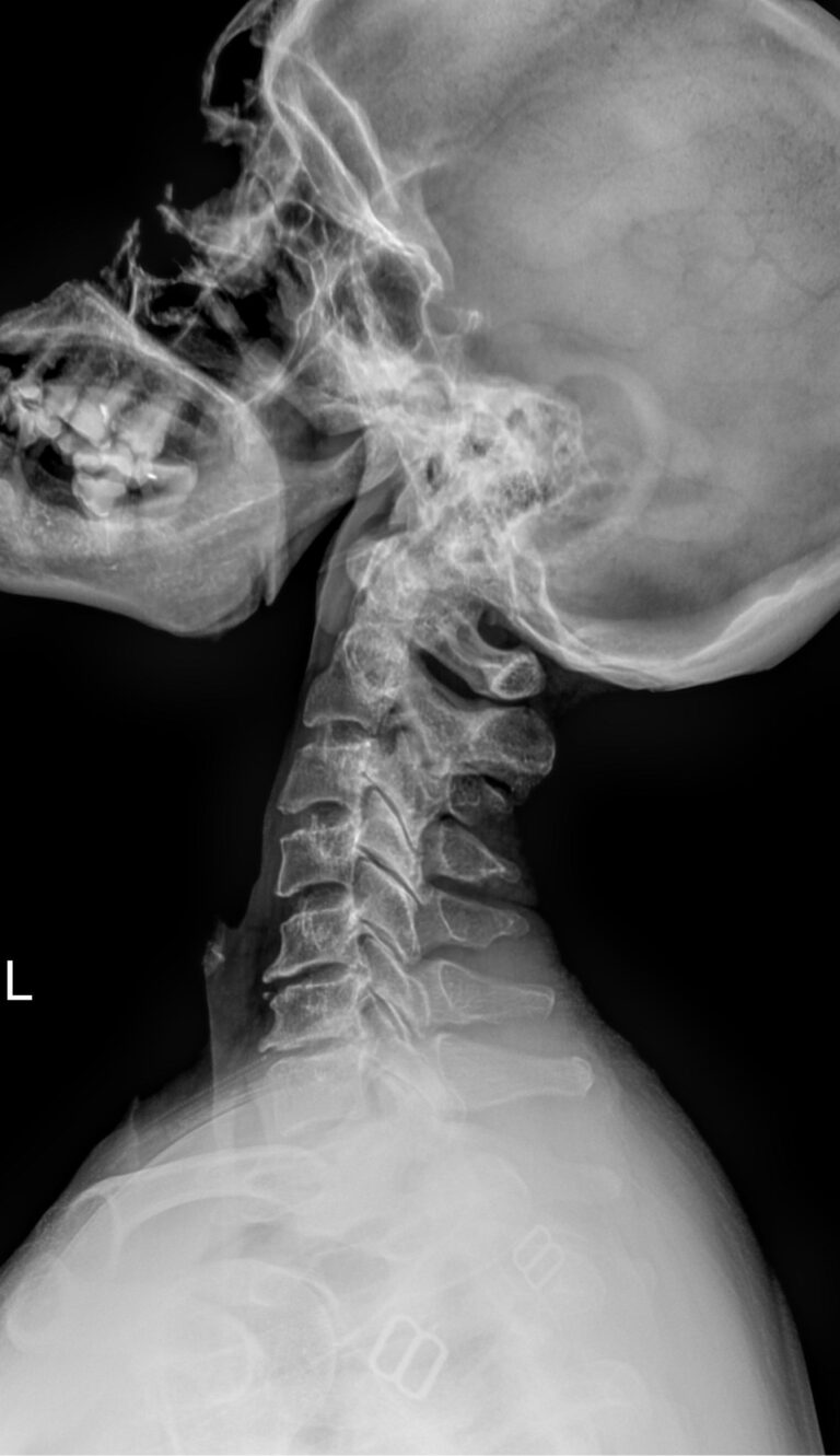 Рентген шейного отдела позвоночника в 2-х проекциях