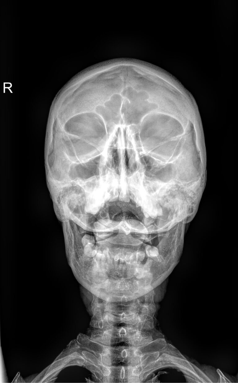 Рентген шейного отдела позвоночника с функциональными пробами