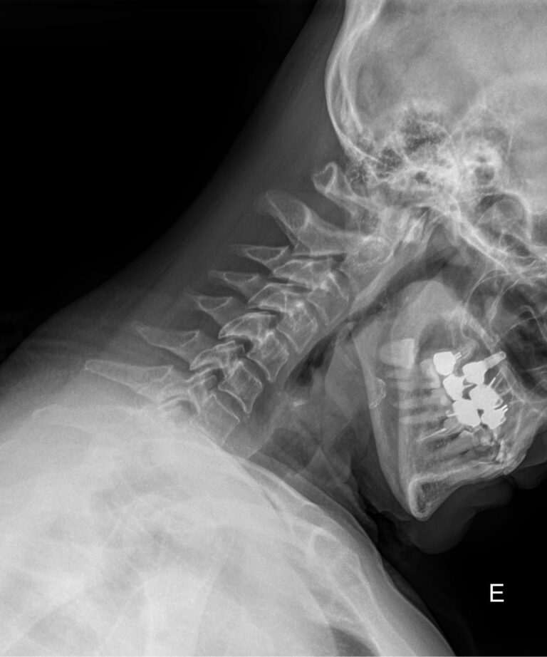 Рентген придаточных пазух носа