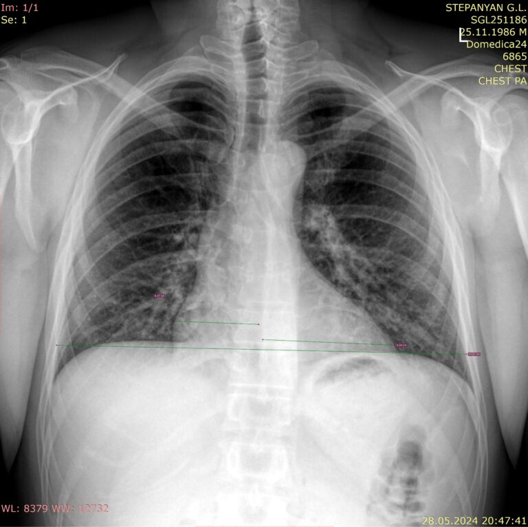 Рентген грудной клетки с определением кардио-торакального индекса