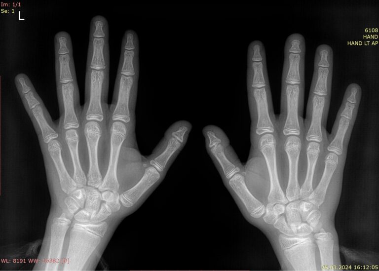 Рентген кистей для определения костного возраста