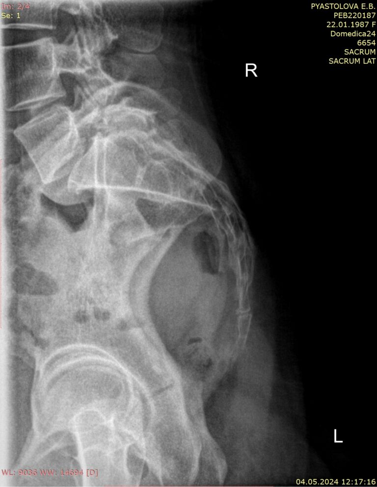 Рентген копчика с функциональными пробами