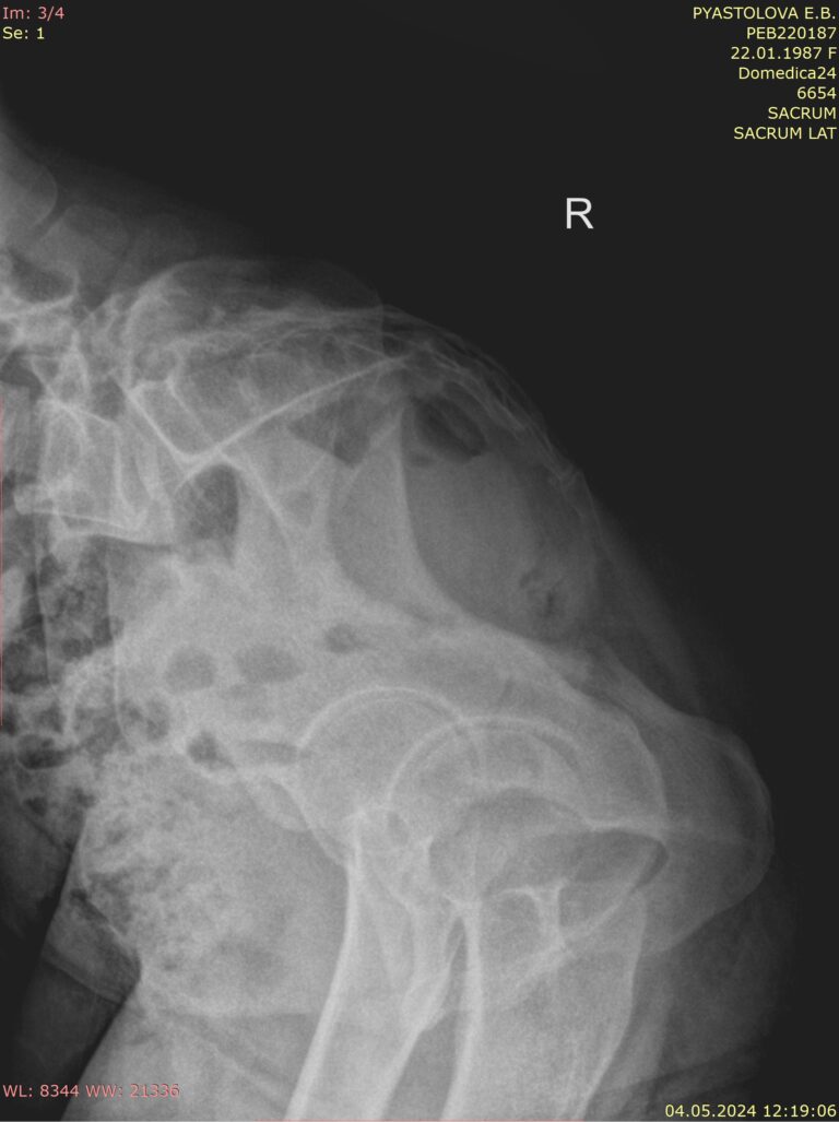 Рентген копчика с функциональными пробами