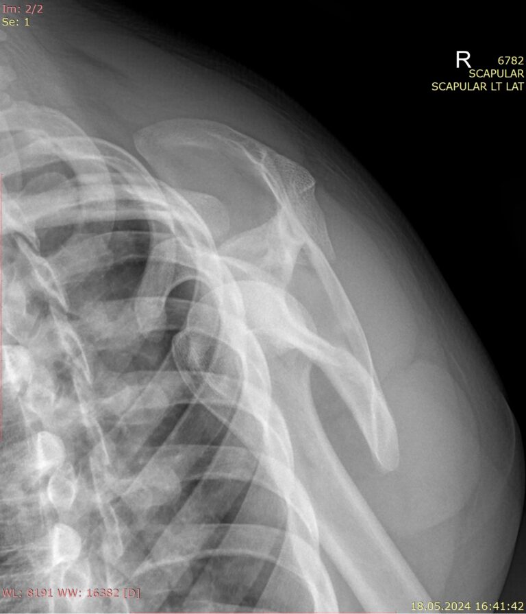 Рентген лопатки