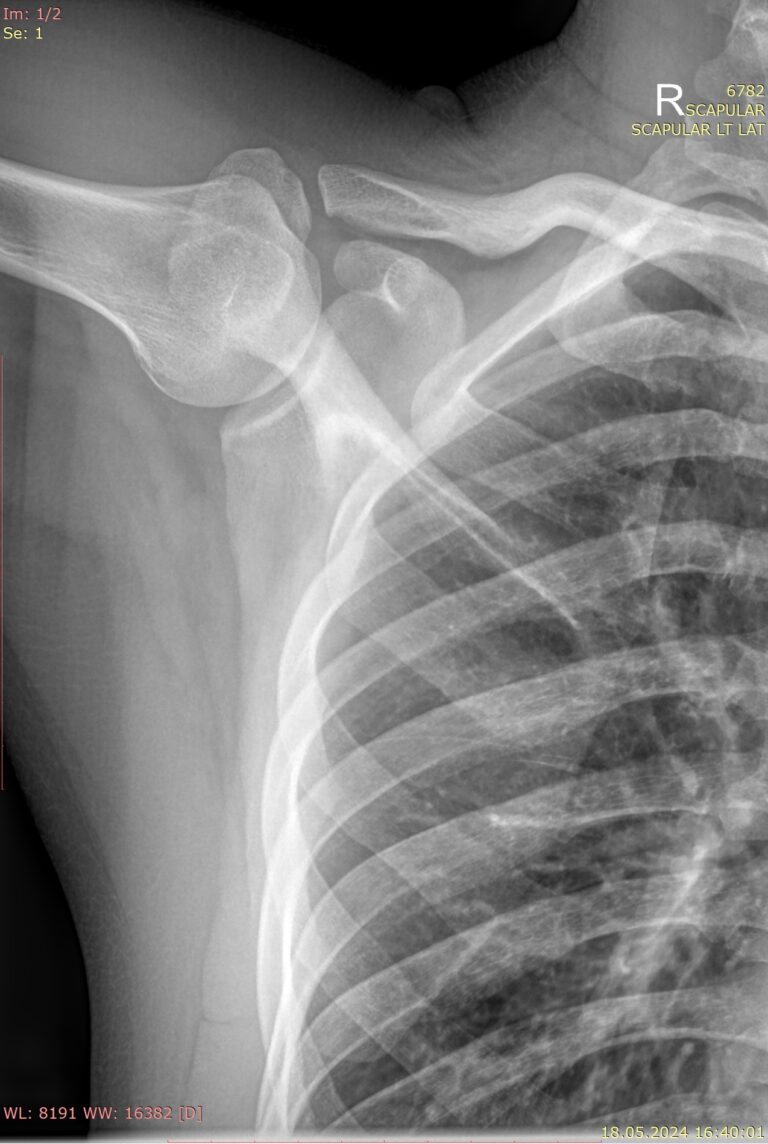 Рентген лопатки