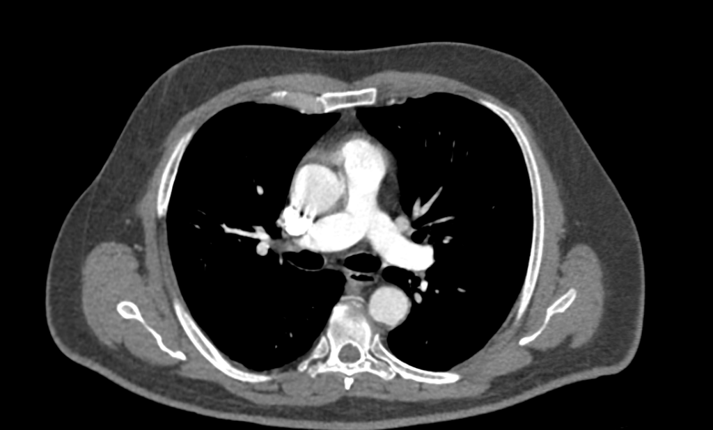 КТ ангиография КТ сосудов