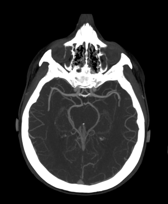 КТ сосудов КТ-ангиография