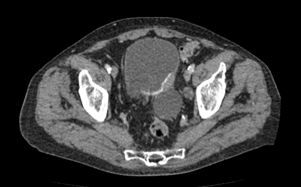 опухоль на КТ КТ контраст опухоль