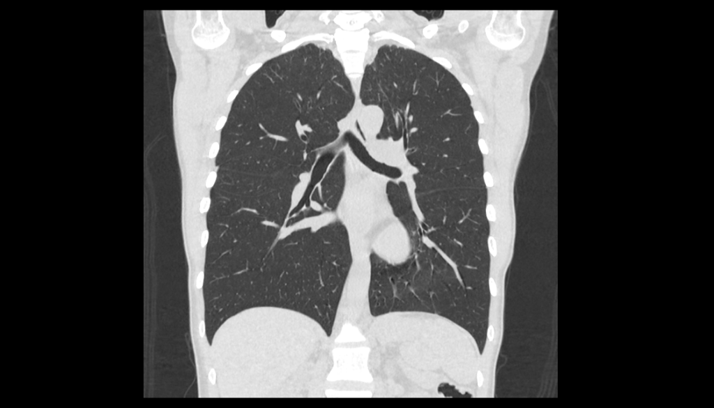 КТ легких компьютерная томография легких