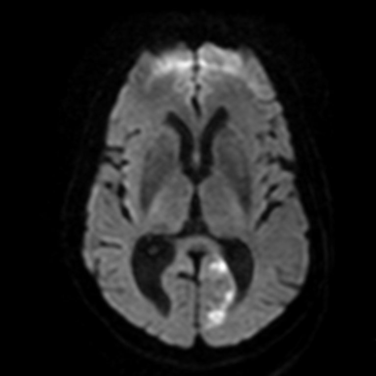 Инсульт на МРТ МРТ инсульта