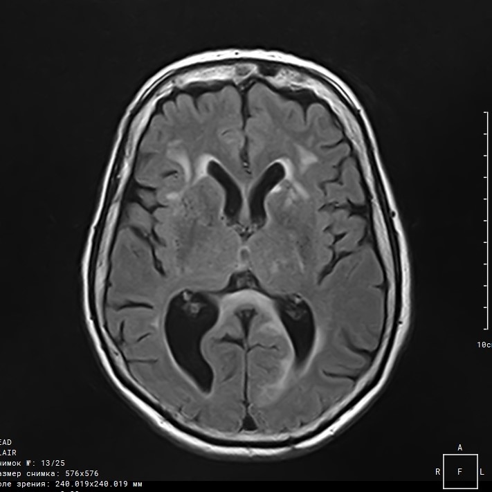 инсульт на МРТ МРТ инсульта