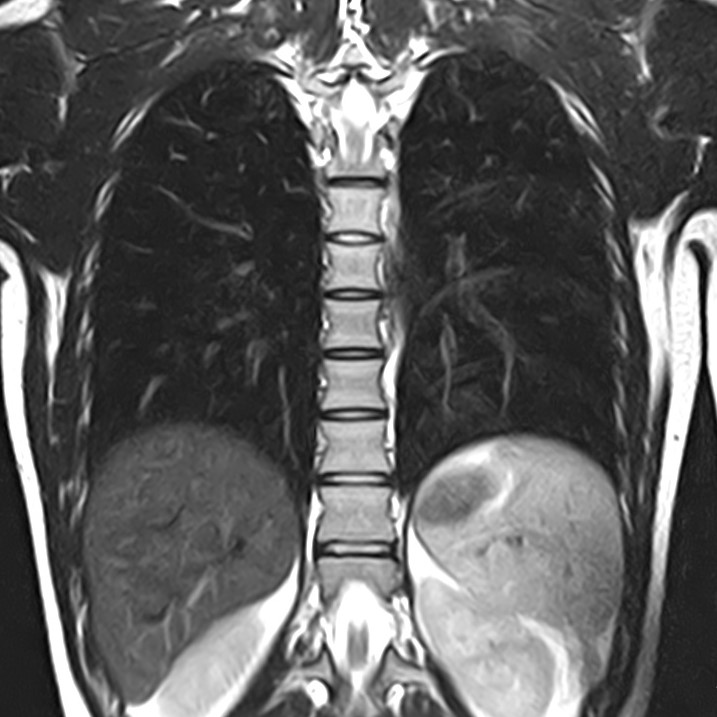 МРТ легких магнитно-резонансная томография легких
