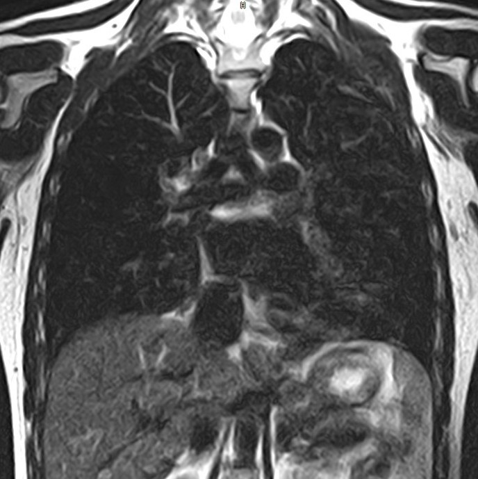 МРТ легких магнитно-резонансная томография легких