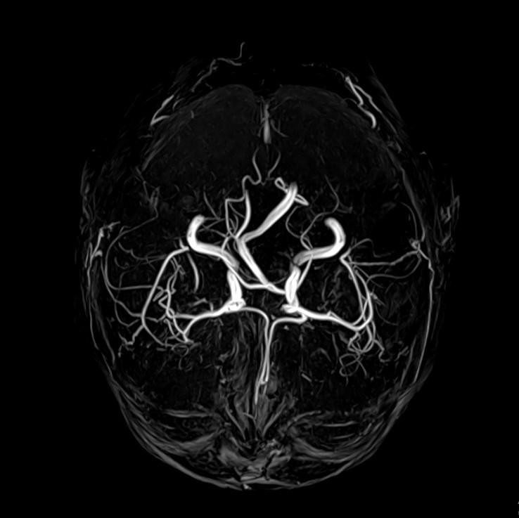 МРТ сосудов МР-ангиография
