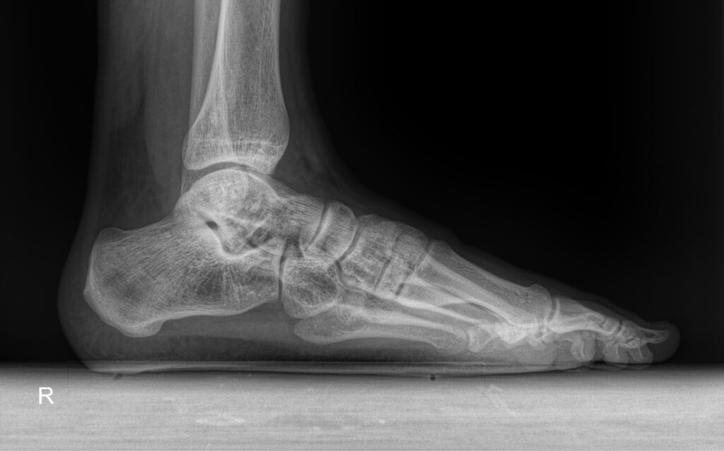 рентген при боли в суставов стопы рентген суставов стопы