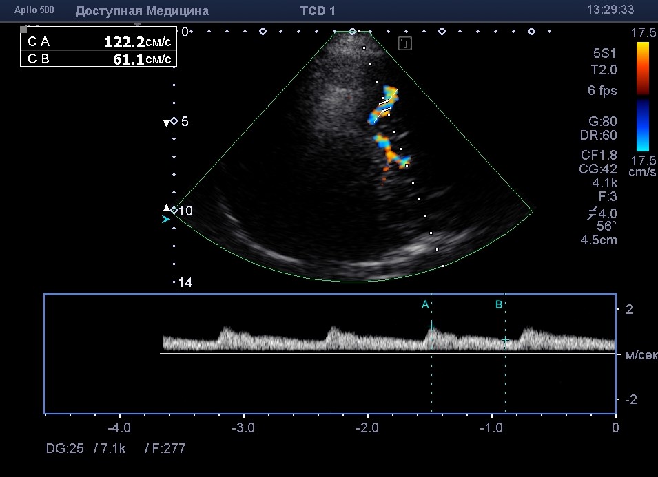 УЗ допплерография УЗИ сосудов