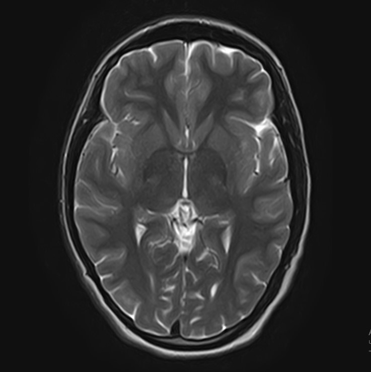 Необходимость МРТ при головной боли