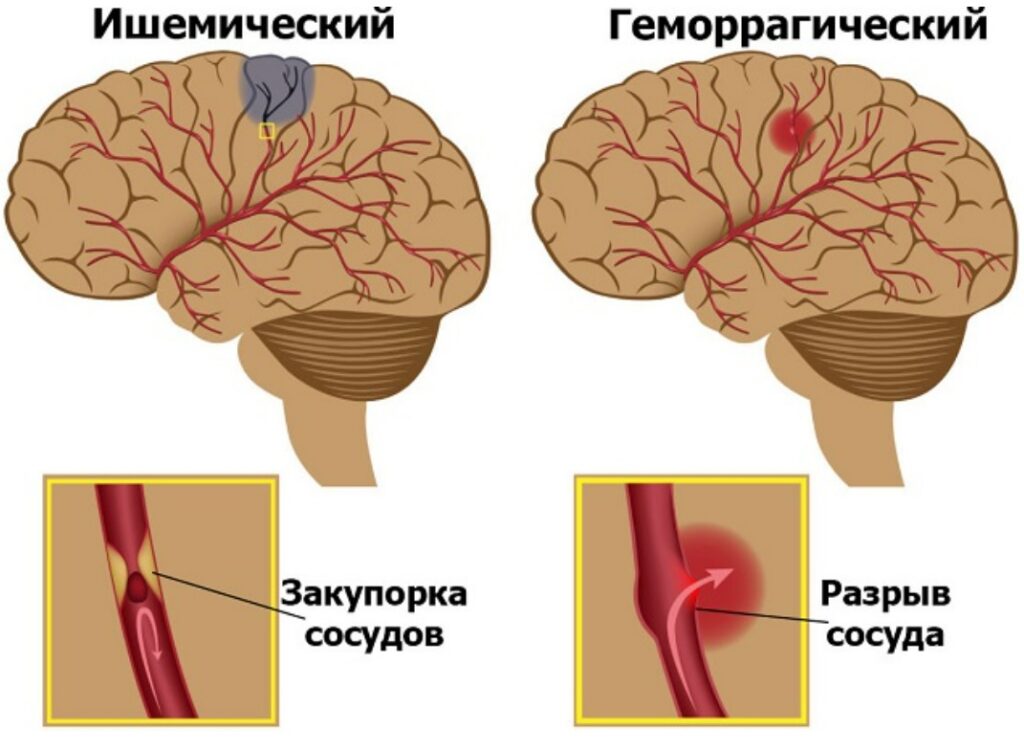 Геморрагический и ишемический инсульт Инсульт