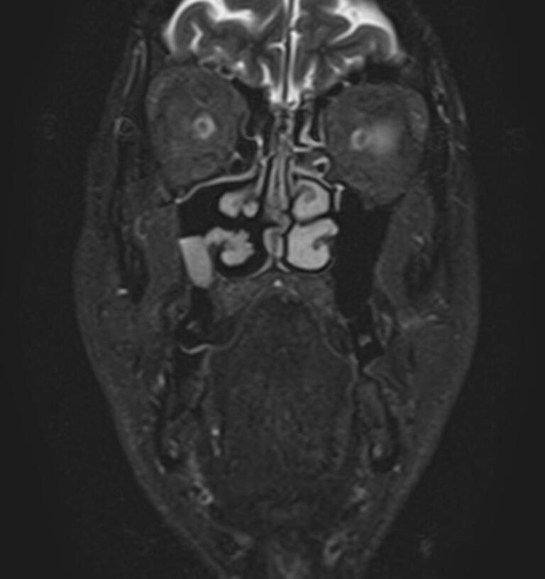 МРТ мягких тканей лица