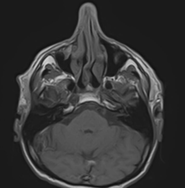 МРТ мягких тканей лица