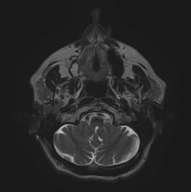 МРТ мягких тканей лица