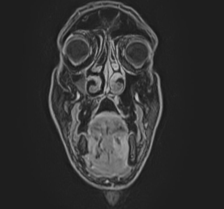 МРТ мягких тканей лица