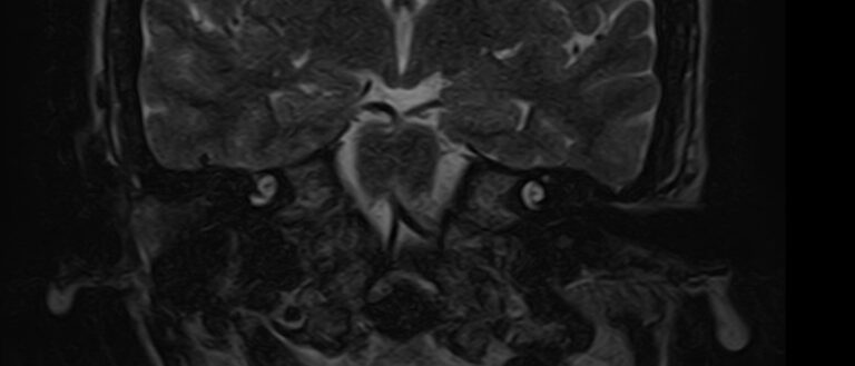 МРТ внутреннего уха