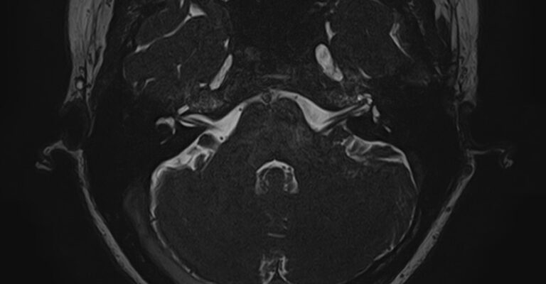 МРТ внутреннего уха