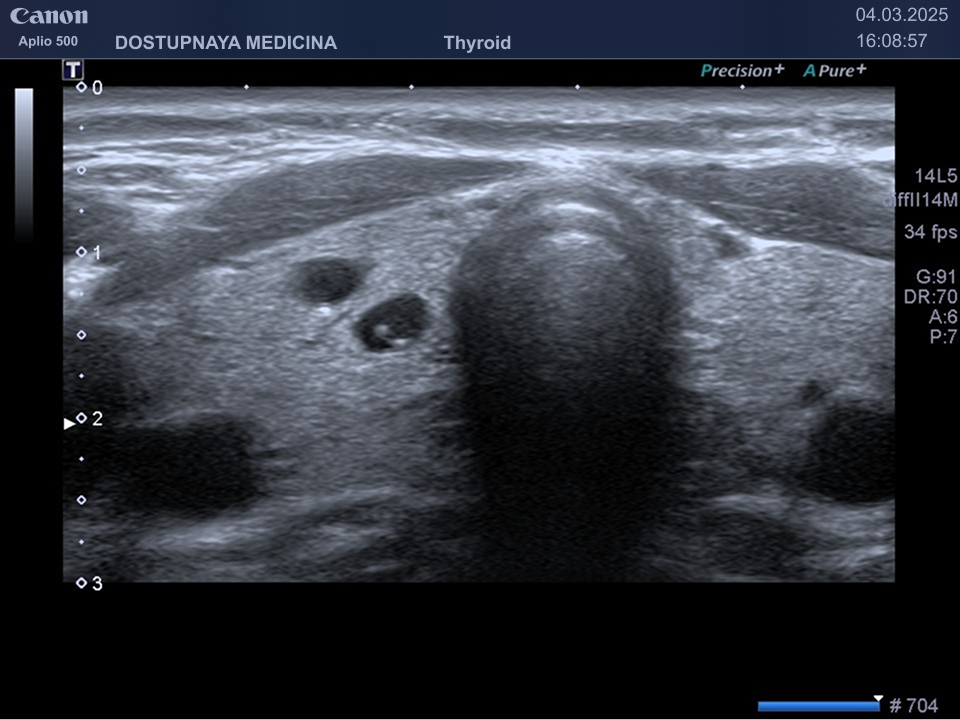 очаговое анэхогенное образование с гиперэогенным включением по типу хвоста кометы, округлой формы, с чёткими, ровными контурами, с горизонтальной ориентацией, не нарушающее форму щитовидной железы, категория по TIRADS 1