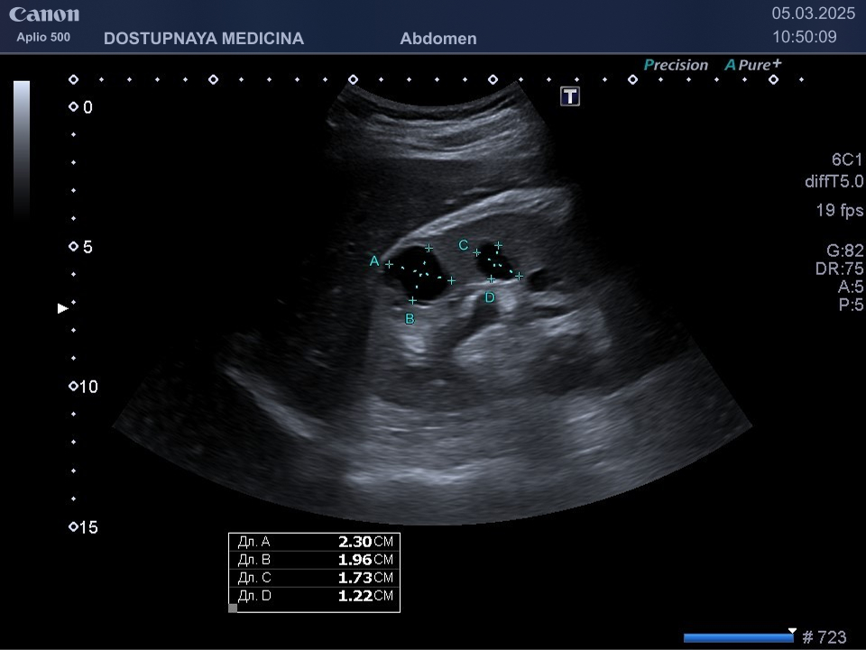 Интрапаренхиматозные кисты правой почки