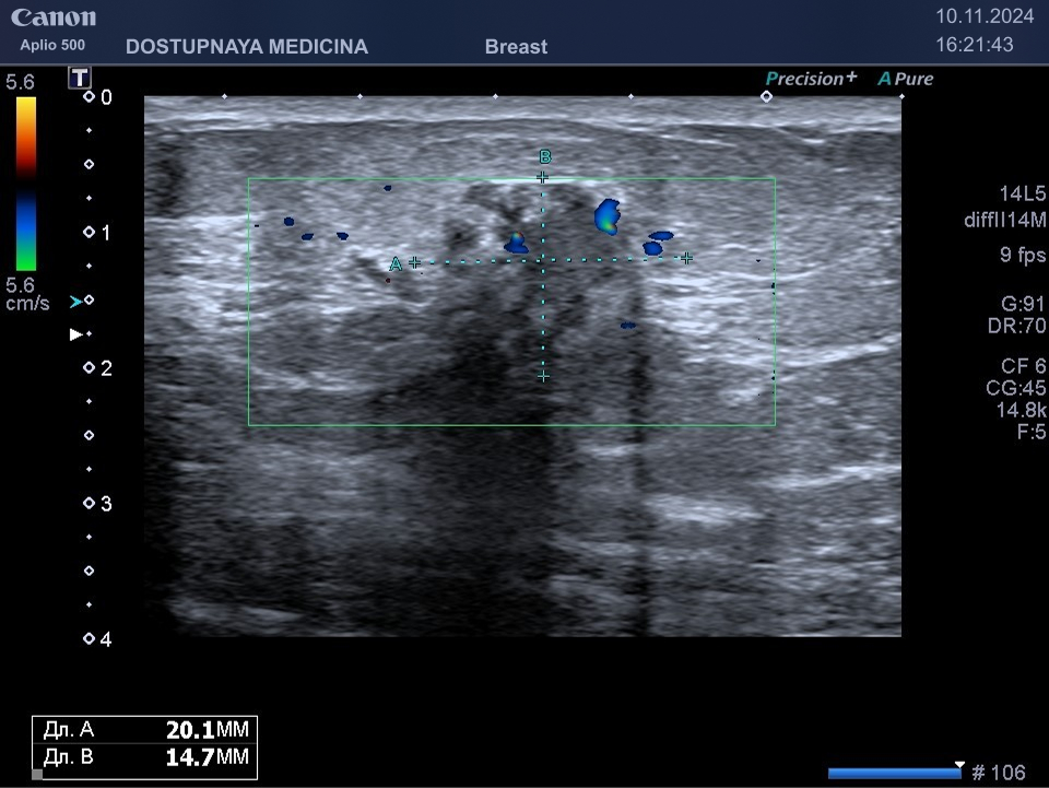впервые выявленное у 50-летней женщины гипоэхогенное образование спикулообразной формы, с нечётким и неровным контуром, с вертикальной пространственной ориентацией, с единичными локусами кровотока в режиме ЦДК, дающее дорсальную акустическую тень, категория BI-RADS V. Рак молочной железы затем подтверждён гистологическим исследованием после трепан-биопсии опухоли.