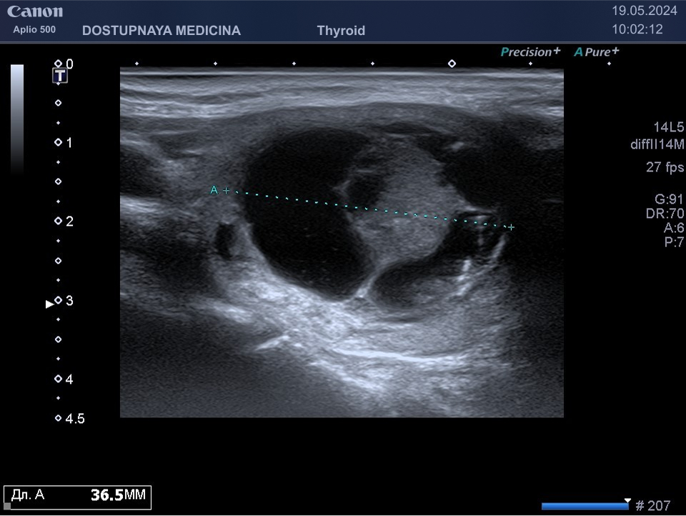 таже пациентка с кистозно-солидным узлом левой доли щитовидной железы, категория TIRADS 5