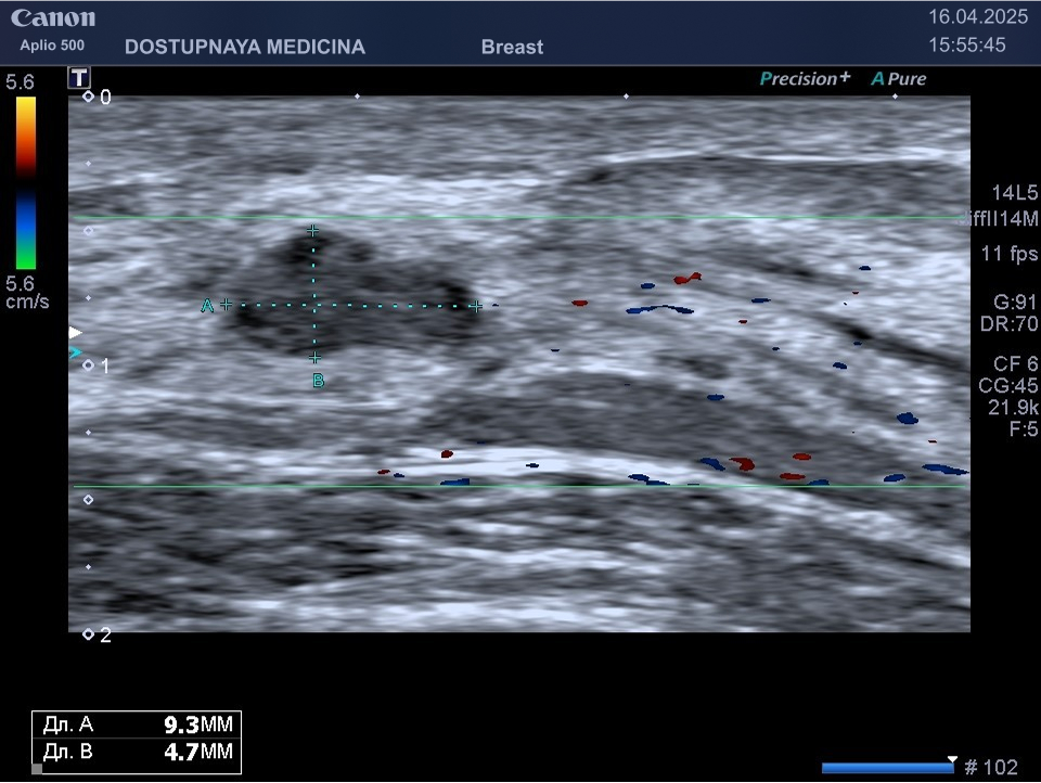 Гипоэхогенное образование в молочной железе у женщины 38-лет. При гистологическом исследовании опухоли после операции выставлен диагноз листовидная фиброаденома.