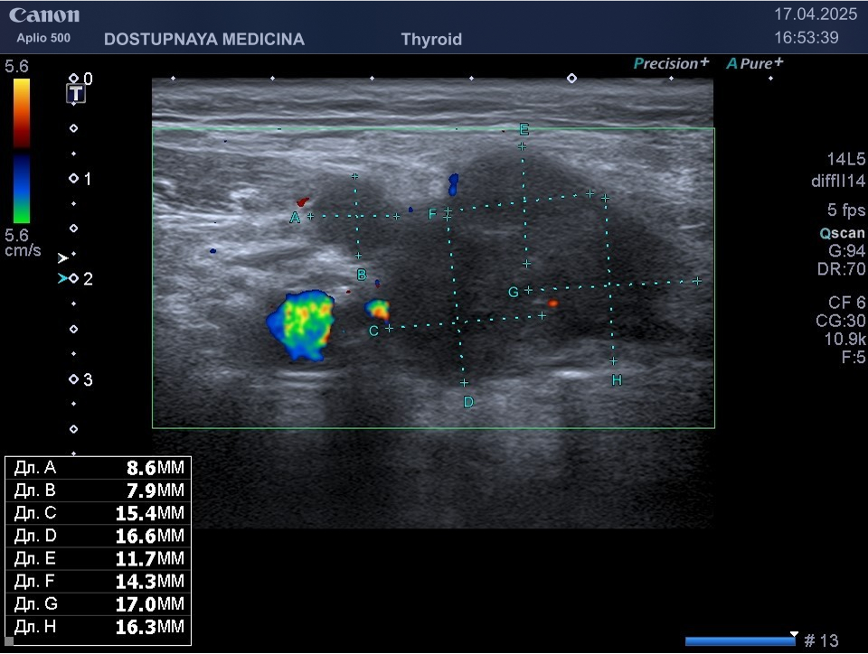 Множественные метастазы рака корня языка в подчелюстные лимфатические узлы
