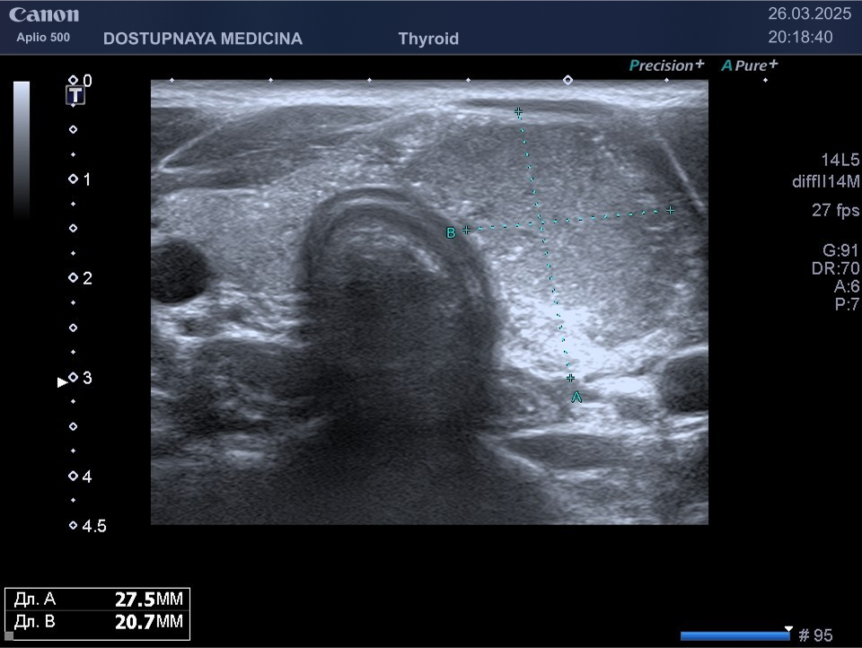 образование солидной эхоструткуры, гипоэхогенное, с не ровными не чёткими контурами, с неопределённой пространственной ориентацией, нарушающее контур житовидной железы, знаимающее всю левую её долю с микрокальцинатами, категория TIRADS 5