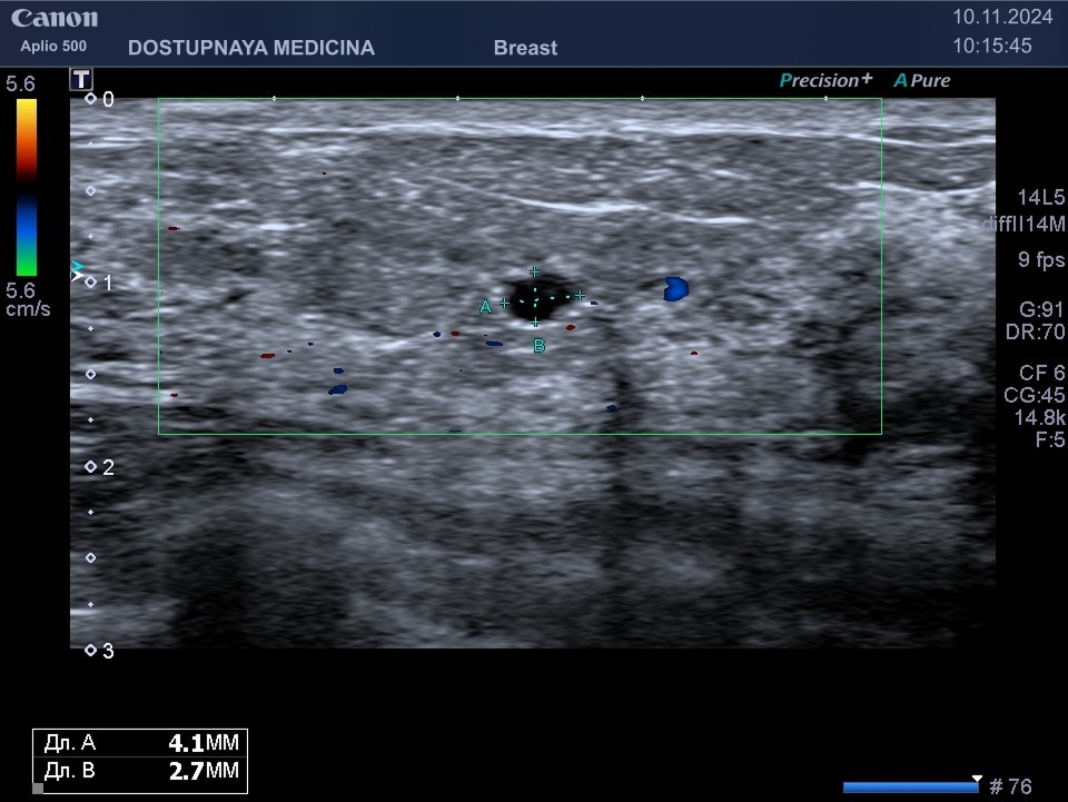 Простая киста с анэхогенным (жидким) содержимым, с дистальным акустическим усилением, без кровотока в режиме ЦДК, категория BI-RADS 2.