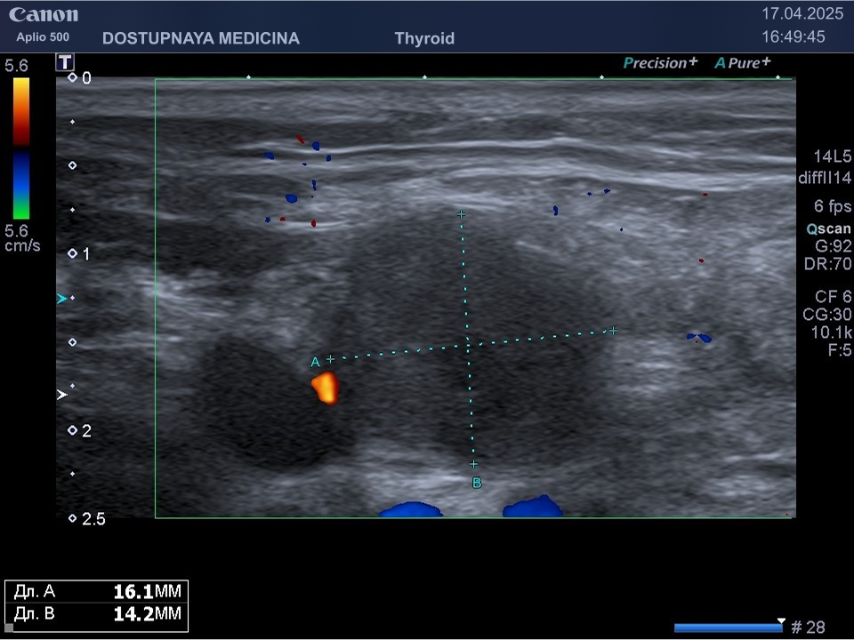 Лимфома с поражением шейного лимфатического узла