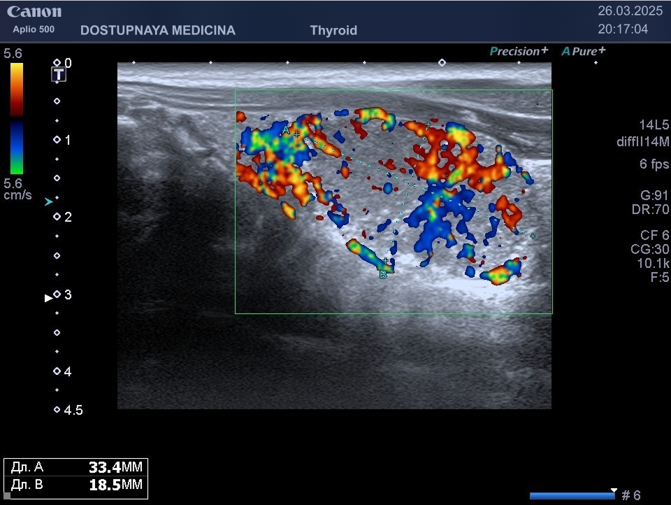образование в режиме ЦДК у того же пациента 27-лет, заключение цитологического исследования после тонкоигольной пункционной биопсии – папиллярная карцинома.