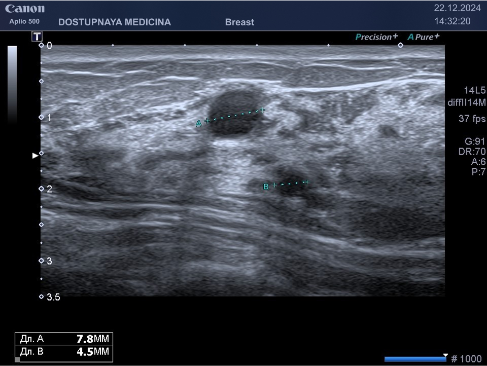 Две кисты с гипоэхогенным (густым) содержимым с дистальным акустическим усилением, без кровотока в режиме ЦДК, категория BI-RADS 2.