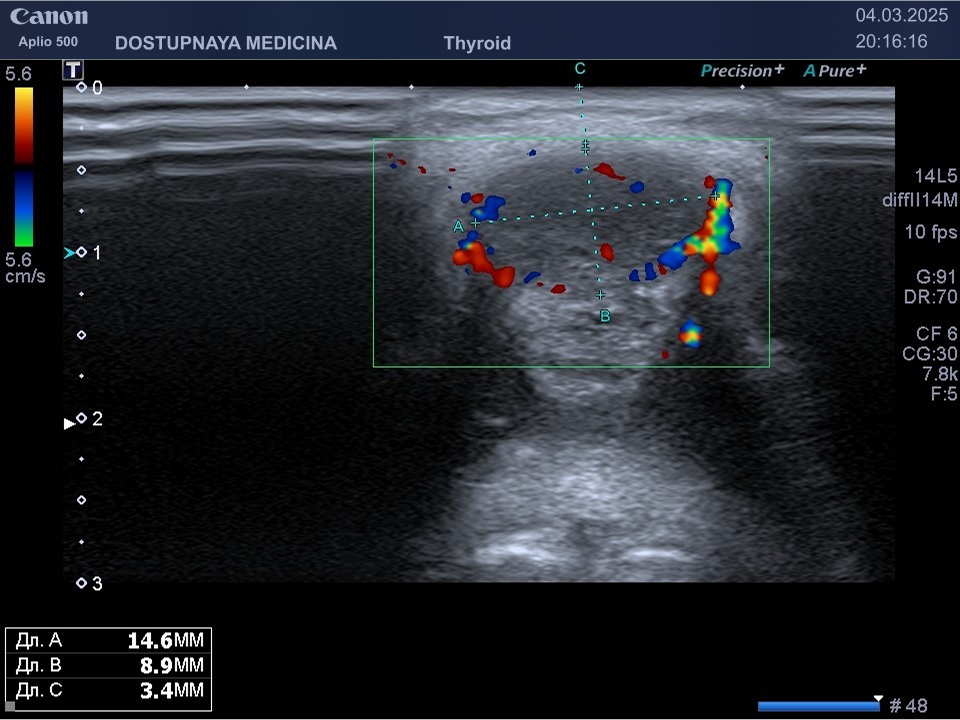 срединная киста шеи у 32-летней женщины с воспалением. Видно, что в режиме ЦДК кровоток по периферии кисты усилен, содержимое кисты гипоэхогенное. Женщина жалуется на боли и незначительное покраснение кожи в области опухолевидного образования по средней линии шеи.